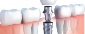Ilustración que muestra la colocación de un implante dental